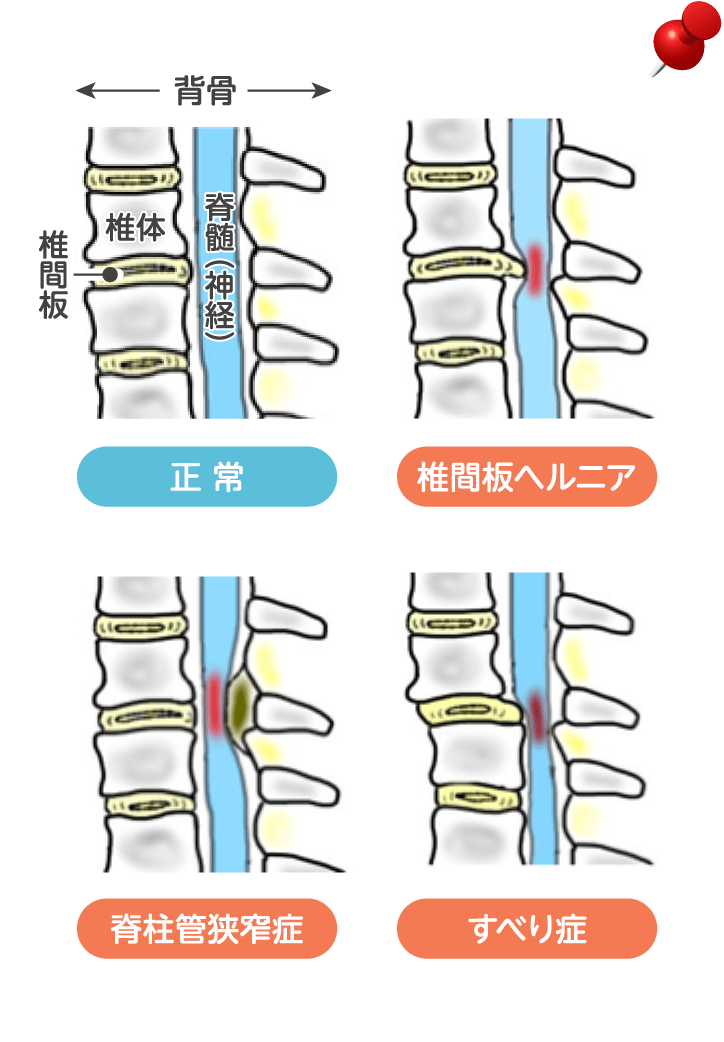 頚椎症・腰椎症イメージ図