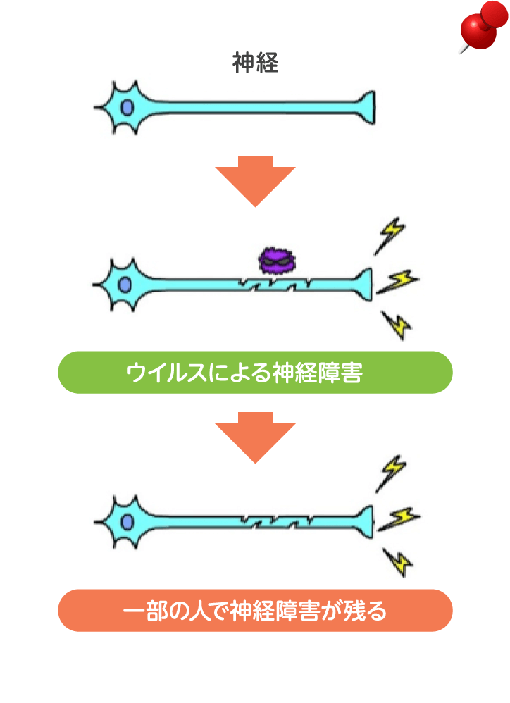 帯状疱疹・帯状疱疹後神経痛イメージ図